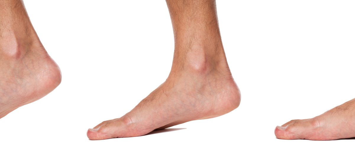 Foot Conditions: Flat Feet