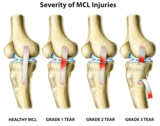 How To Deal With An MCL Injury