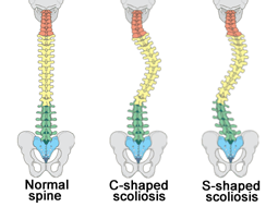 The Spinal Series: Scoliosis
