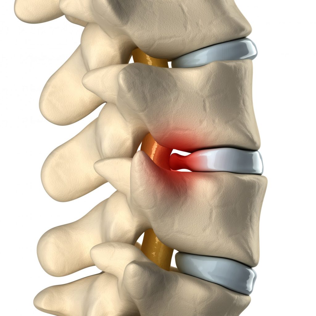 The Spinal Series: Herniated Disc