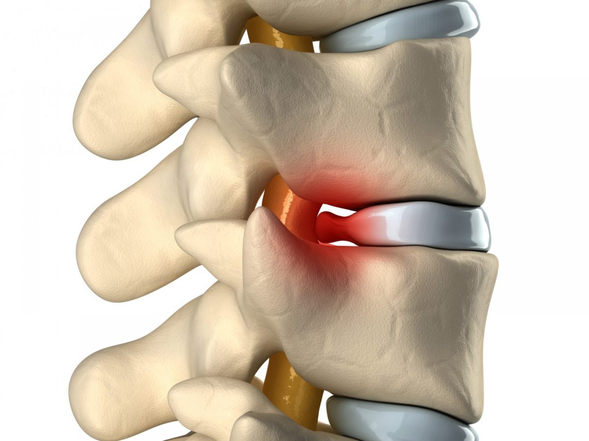 The Spinal Series: Herniated Disc