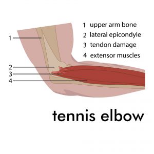 SportsMed Physical Therapy Tennis Elbow - Anatomy